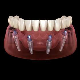 All on 4  Dental Implants